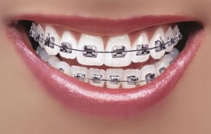 playing flute with braces
